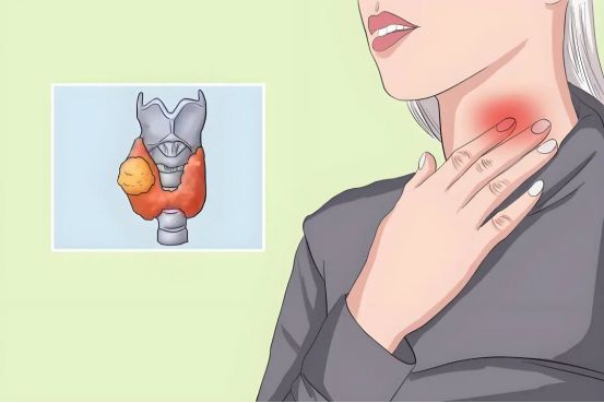 为什么女性更容易成为甲状腺结节的“目标”？